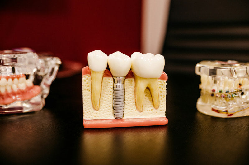Model of a tooth after a root canal